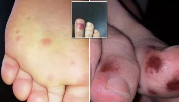 علامات القدمين رصدت بشكل أساسي لدى الأطفال والمراهقين