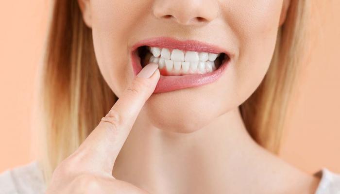 أسباب تورم اللثة وطرق العلاج