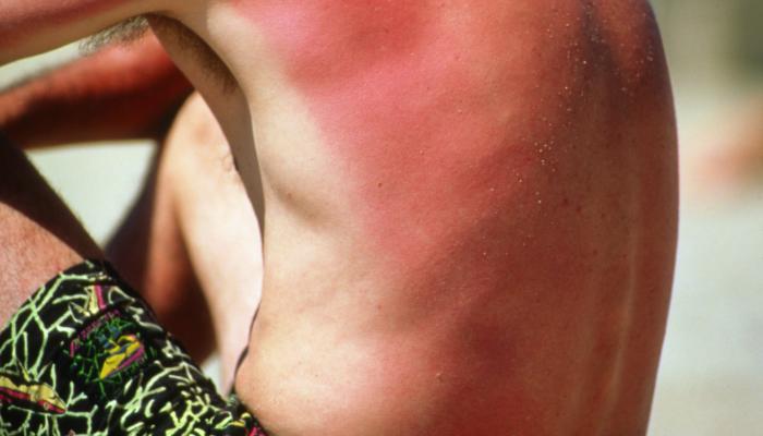 أي التهاب يصيب البشرة بسبب أشعة الشمس يزيد خطر الإصابة بسرطان الجلد