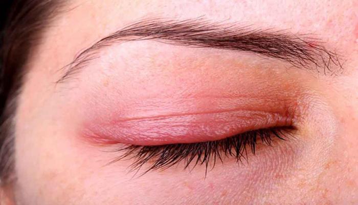 التهاب الجفون من أمراض العيون الشائعة