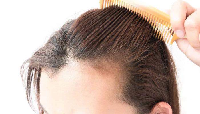 نجمة ماكينة الخياطة عرض  طرق علاج تساقط الشعر