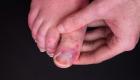 أحدث أعراض كورونا.. دراسة تفسر سر الإصابة بأصابع الكوفيد