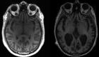 La cause de la progression de la maladie d'Alzheimer dans le cerveau découverte