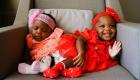 Kamerun'lu yapışık siyam ikizleri, Türkiye'de şifa buldu