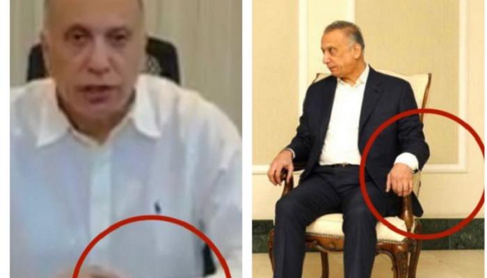 ظهور إصابة الكاظمي على مستوى اليد