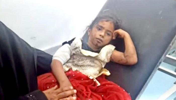 طفلة مصابة جراء انفجار اللغم الحوثي