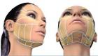 هایفو؛ فناوری پیشرفته‌ای برای زیبایی صورت