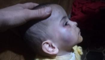 آثار الضرب على وجه إحدى الطفلتين