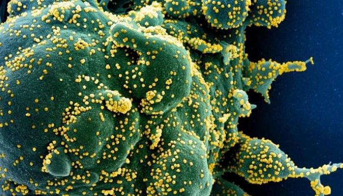 صورة مجهرية إلكترونية لخلية مصابة بشدة بجزيئات الفيروس