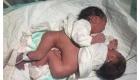 تولد دوقلوهای به هم چسبیده در هرات
