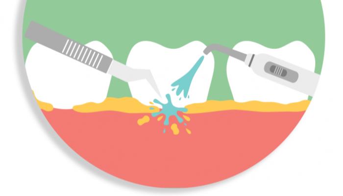 التخلص من جير الأسنان.. 4 وصفات طبيعة‎