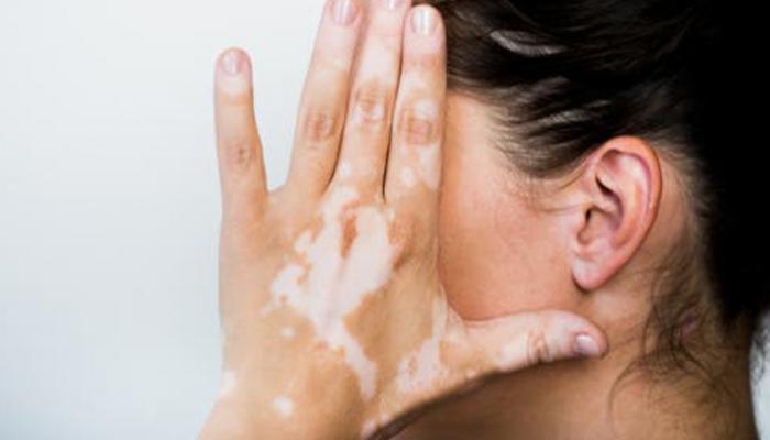 أعراض مرض البهاق