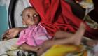 سوء التغذية الحاد يهدد حياة 100 ألف طفل في تيجراي بإثيوبيا
