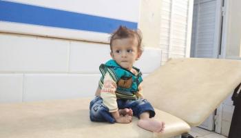 طفل يمني يعاني من سوء التغذية