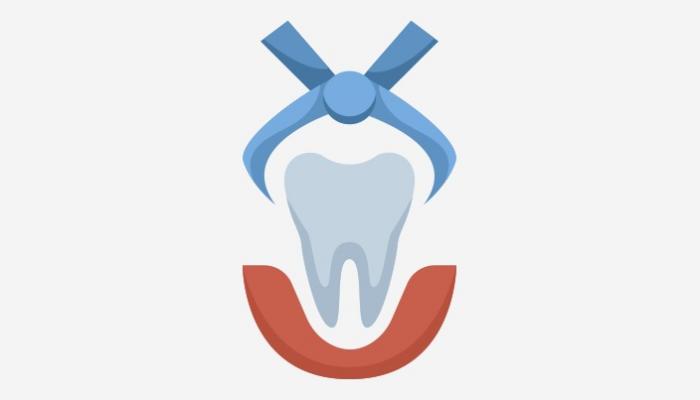 Yirmilik Diş Çekimi: Herkesin Bilmesi Gereken Altı Nokta