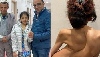الطفلة ماريا بعد 6 ساعات من إجراء عملية إصلاح الإعوجاج بعمودها الفقري