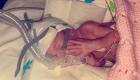 نوزاد بریتانیایی زودرس که با بیماری نادر پا به دنیا گذاشت (+تصاویر)