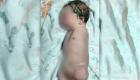 یک نوزاد در افغانستان بدون دست به دنیا آمده است