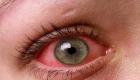احمرار العين.. أعراض تستوجب زيارة الطبيب
