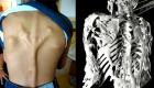يحول العضلات إلى عظام.. دراسة تكشف أسرار "المرض الغامض"