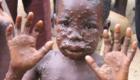  Cameroun: Le Sud Ouest frappé par variole du singe 