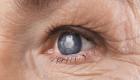 الجلوكوما ومخاطر فقدان البصر.. احذر قلة النوم والأرق
