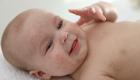 الحساسية الغذائية لدى الرضع.. دراسة تحل اللغز