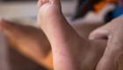 مرض اليد والقدم والفم لدى الأطفال.. يهدد بالشلل