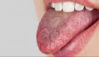 جفاف الفم بعد علاج السرطان.. 10 نصائح لتخفيف الشعور المزعج