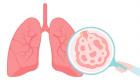 Pulmoner fibrozis belirtileri