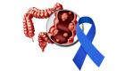 Cancer colorectal, comment s’en protéger ?