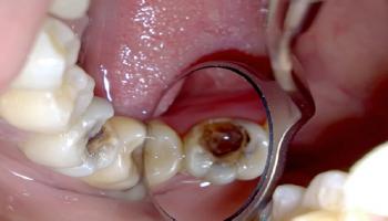 علاج التهاب لب الأسنان يختلف حسب شدة الإصابة