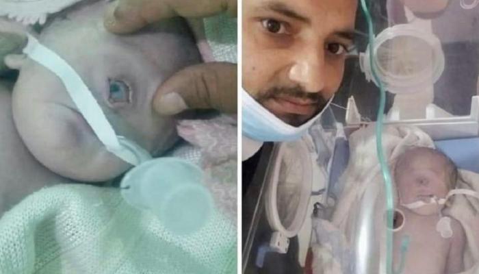 ولادة طفل بعين واحدة في اليمن