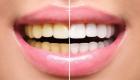 8 مخاطر لجلسات تبييض الأسنان.. أضرار صحية كبيرة
