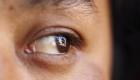 مؤشرات ارتفاع الكوليسترول في الدم.. أحدثها عوامات العين
