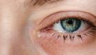 الضمور البقعي.. علماء يقتربون من علاج أكثر أشكال العمى شيوعا