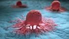 يذيب الورم.. فيروس فاكسينيا يخوض معركة البشر ضد السرطان