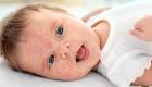 حساسية الألبان لدى الرضع.. احذري هذه الأعراض