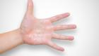 نصائح صيفية.. 5 علاجات منزلية للأيدي والأقدام المتعرقة
