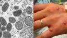 Maroc : trois cas suspects de la variole du singe