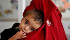 سیگار: بیش از ۳ میلیون کودک در افغانستان در معرض سوءتغذیه قرار دارند