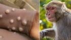 شناسایی اولین مبتلا به آبله میمون در افغانستان