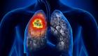 Sigara mesane ve akciğer kanseri birlikteliğini artırıyor