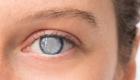 إعتام عدسة العين.. 10 عوامل تهدد بالعمى