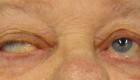 8 علامات للوهن العضلي المزمن.. العين الأكثر ضرراً