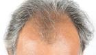 Alopécie: Quelle relation entre la croissance des cheveux et le système immunitaire?