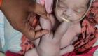 Garip ama gerçek: Hindistan'da dört kollu ve dört bacaklı bebek doğdu