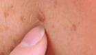 تأثير العلاج بالكورتيزون على الجلد.. نصائح لتجنب المتاعب