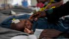 الحصبة تقتل 157 طفلا في زيمبابوي خلال أسبوعين