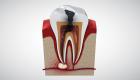 أسباب وعلاج التهاب جذور الأسنان (إنفوجراف)